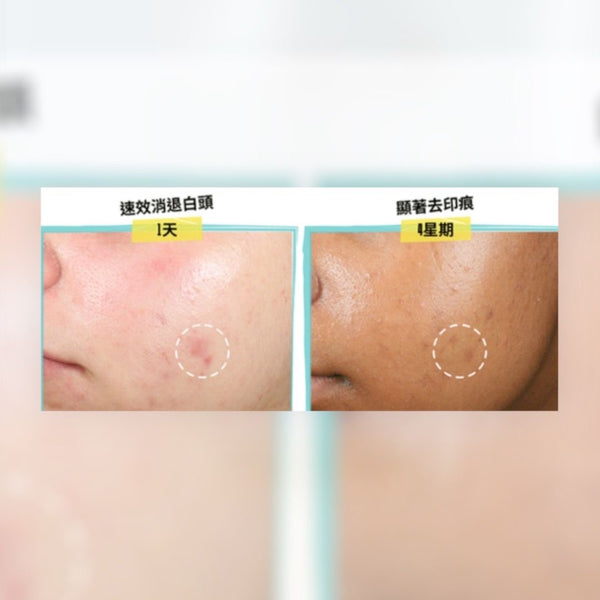 Kiehl's 醫學水楊酸抗粉刺精華液體貼 15ml 液體無痕痘痘分手貼