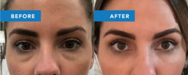 Juvelook Volume PLA/HA Hybrid filler 200 mg/vial 豐盈(黑瓶) 韓國內銷版