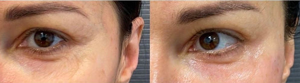 Juvelook Volume PLA/HA Hybrid filler 200 mg/vial 豐盈(黑瓶) 韓國內銷版