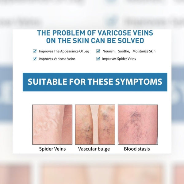 OUHOE Varicose veins soothing cream 20g 靜脈曲張膏