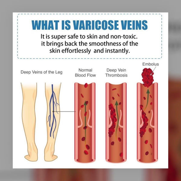 OUHOE Varicose veins soothing cream 20g 靜脈曲張膏