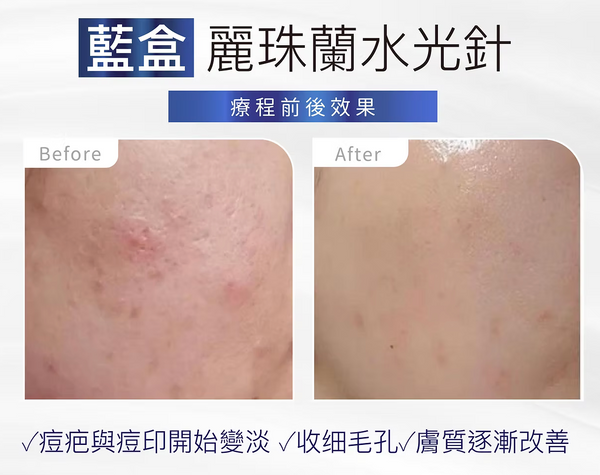 Rejuran 藍盒 麗珠蘭水光針💙5大功效 唯一PN濃度最高 疤痕修復的「局部專家」
