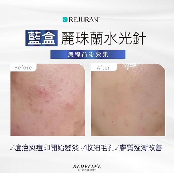 Rejuran 藍盒 麗珠蘭水光針💙5大功效 唯一PN濃度最高 疤痕修復的「局部專家」